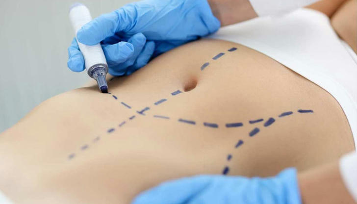 Before surgery, what is commonly marked on the body to prevent errors?