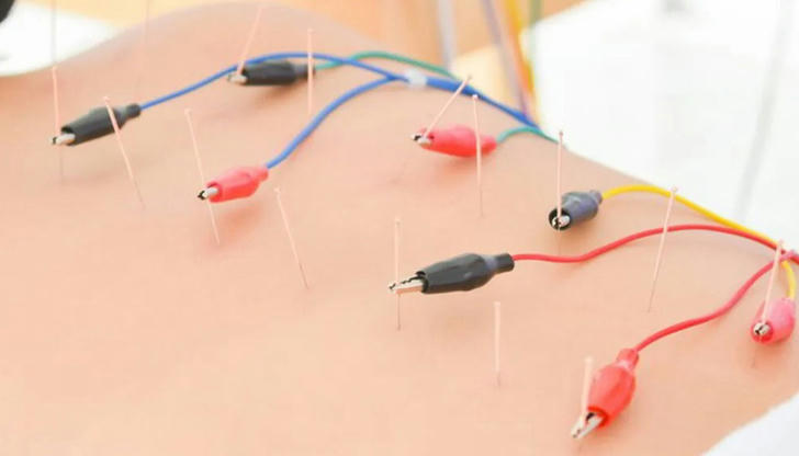 Needles with mild electric current. Which therapy is this?