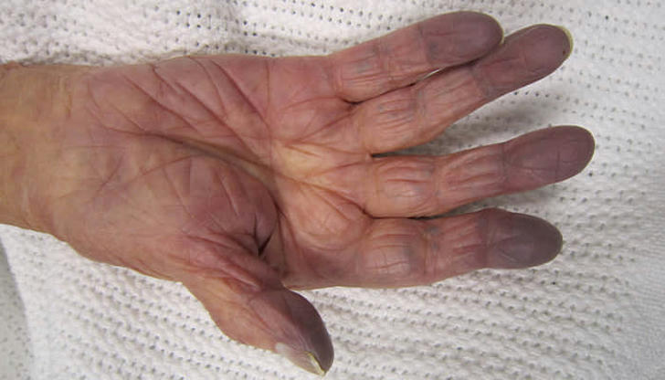 What’s the medical term for tissue death caused by lack of blood flow?